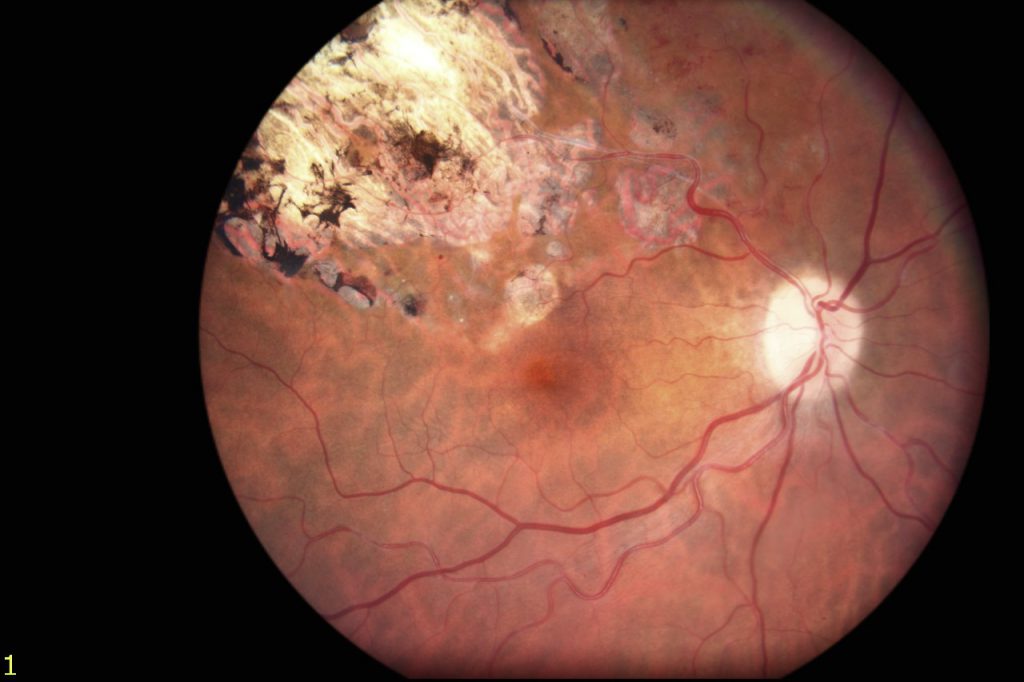 fundusphotowebcolor3-fundus-photo